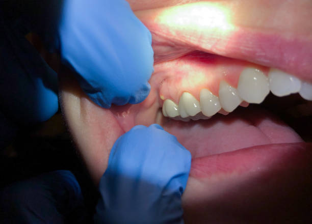 Best Urgent Care for Lost Fillings or Crowns in Malibu, CA